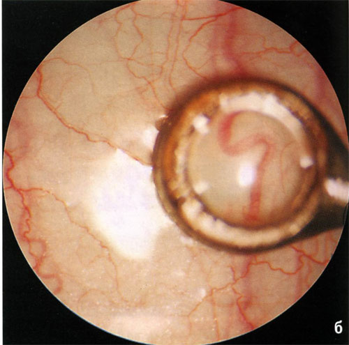 Рис. 4. Процесс вазотонометрии: б - микролинза вазотонометра над верхней ПЦА