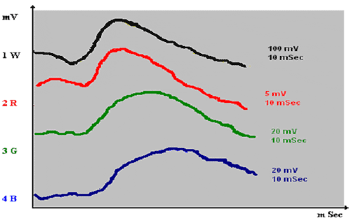 Шамшинова Рис. 2. Максимальная и макулярная ЭРГ в норме: 1 W - максимальная общая ЭРГ на белый стимул; 2 R - макулярная ЭРГ на красный стимул; 3 G - макулярная локальная ЭРГ на зеленый стимул; 4 B - макулярная локальная ЭРГ на синий стимул