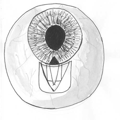 Схематичное изображение глаза после операции