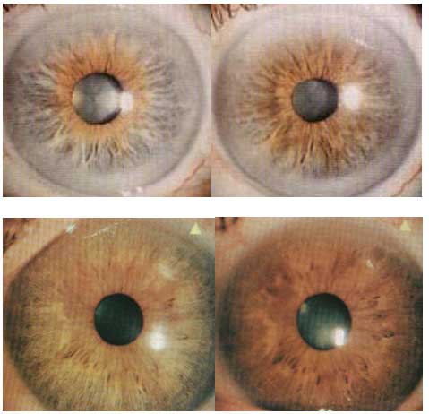 Глаза пациентов с концентрической гетерохромией радужной оболочки до и через 9 мес. после начала лечения ксалатаном
