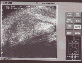 Ультразвуковая биомикроскопия фильтрационной подушки через 2 мес. после операции