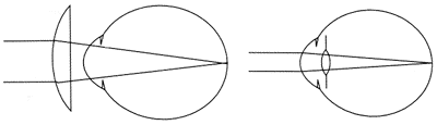 Схема очковой и внутриглазной коррекции афакии